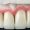 Ceramic dental bridge on plaster model. Dental prosthesis manufacturing workshop. Selective focus. Dental implant. Restoration of teeth. Dental laboratory, clinic. Implants of the jaw of person. Visual materials at the dentist's office